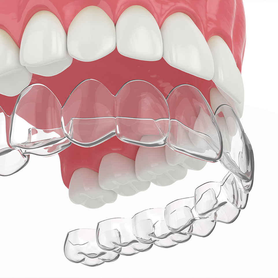 Comment et pourquoi utiliser une gouttière d'alignement dentaire ? -  Dentifree